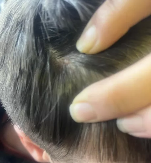 Is this a mole or cyst?? by Superb_Appearance559