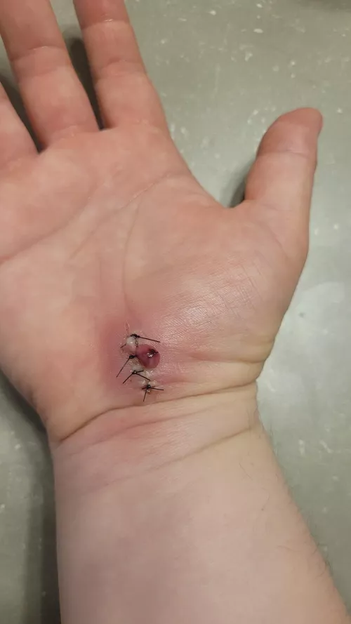 Carpal tunnel release incision got infected the day before my follow-up and suture removal. Managed to release some pressure. Cleaned up and surgeon contacted for antibiotics. NSFW due to bloody discharge and sutures/incision. by basicgutter