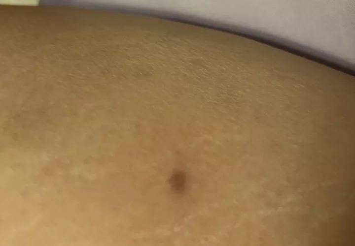 Is this an ingrown hair? A bump but doesn't hurt when touched by polkadottedcloud