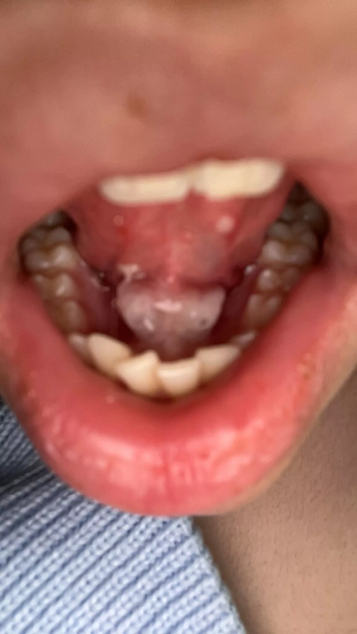 look who came back😃 why are my salivary stones always massive posted by Winter_Jellyfish1999