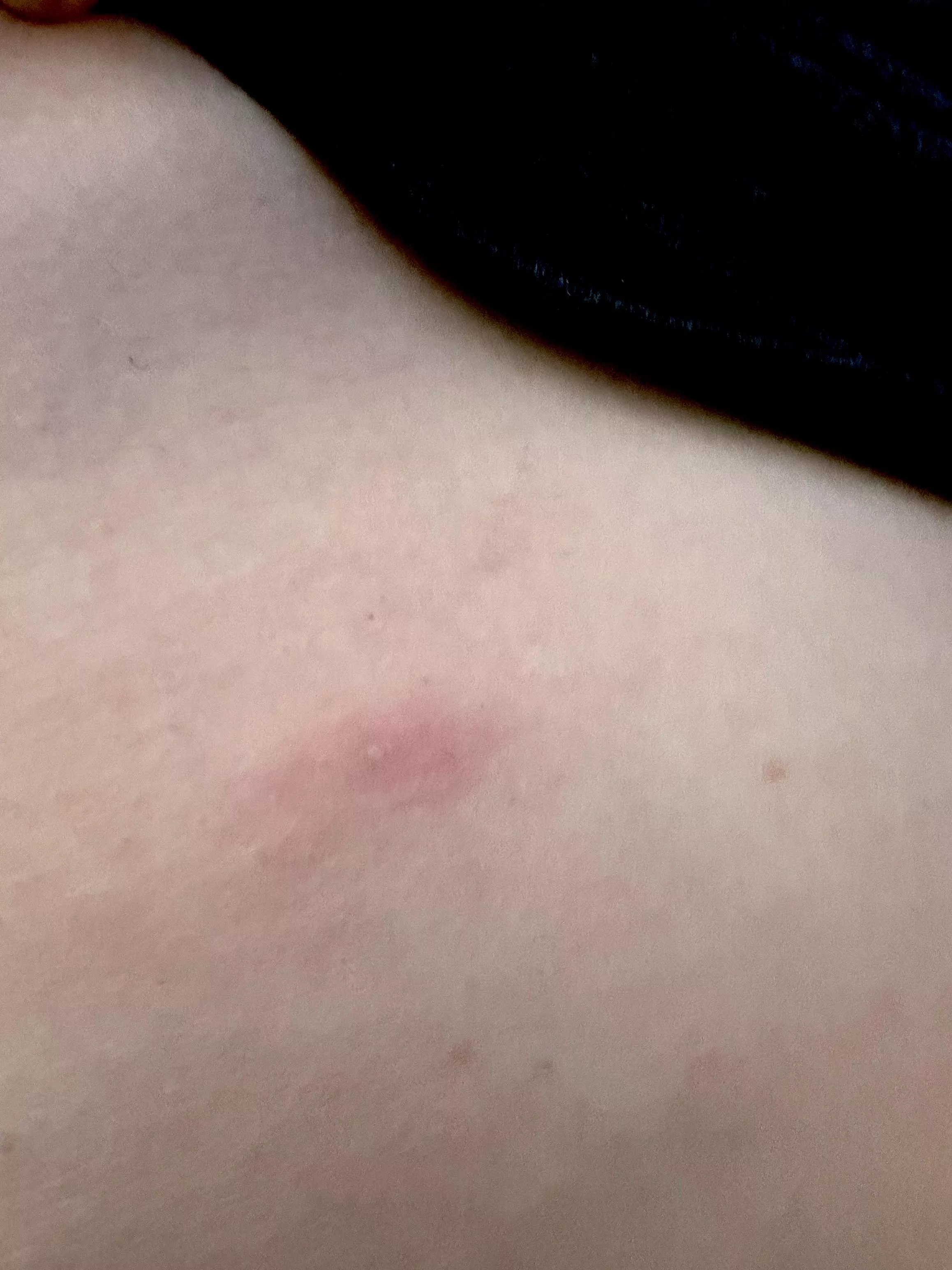 My neighbors honey bees + light yard work = forbidden pop on upper ribcage. posted by tumblrisdumbnow
