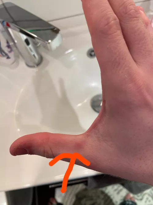 weird bump on my thumb by CapNcook99