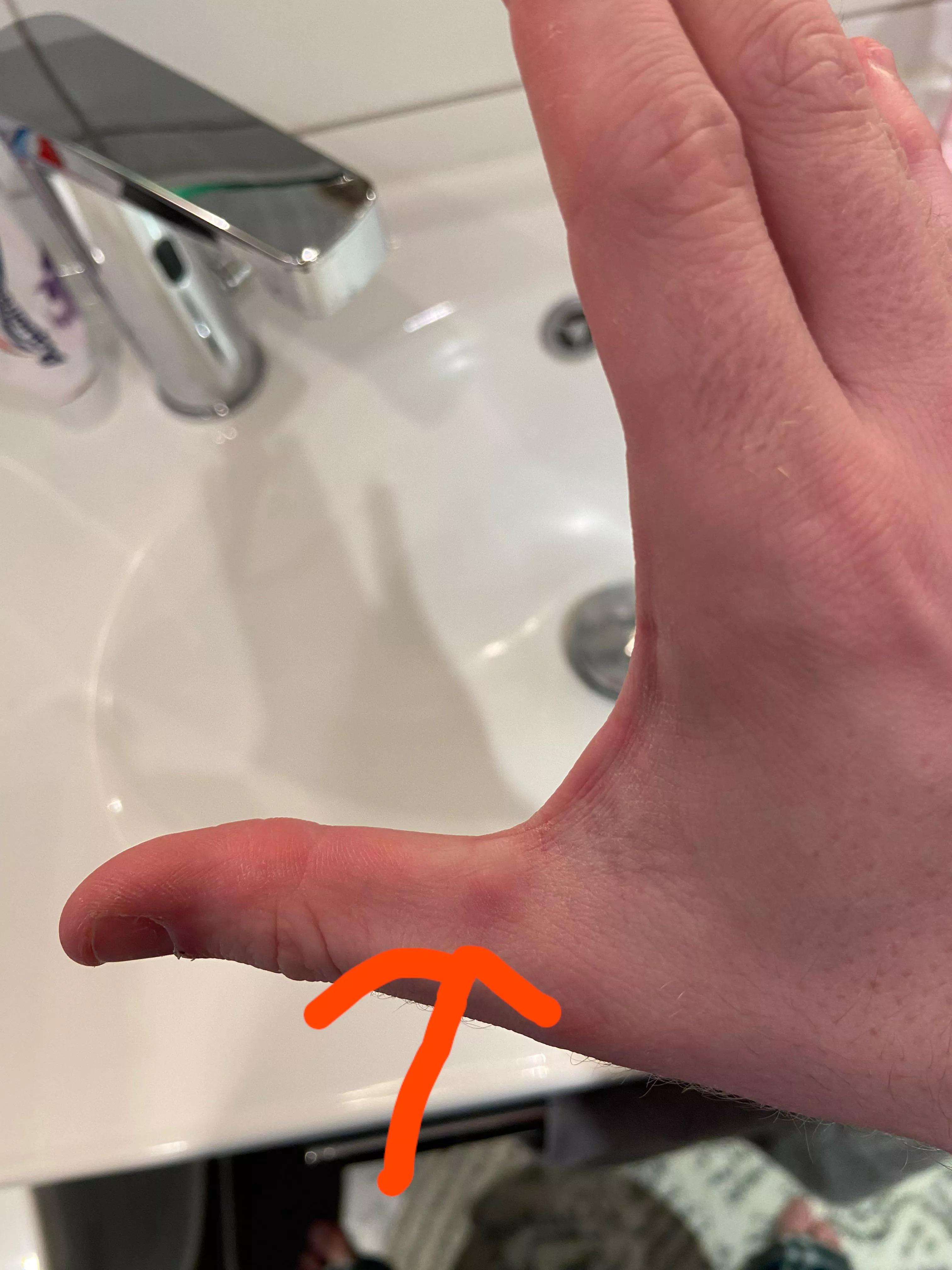 weird bump on my thumb posted by CapNcook99