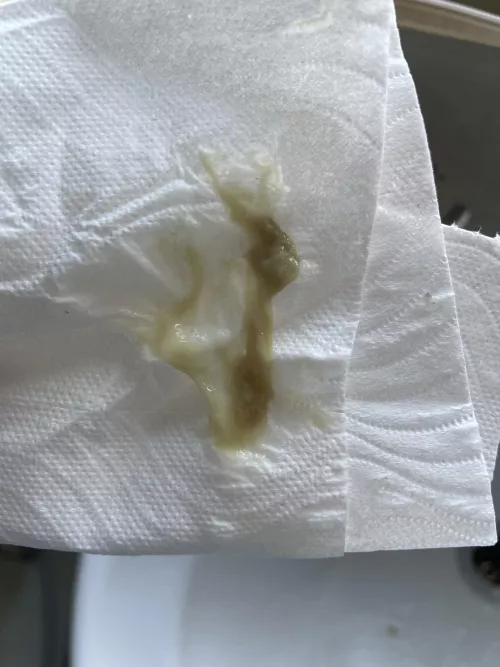 This practically crawled out my nose after a 3 month sinus infection  by marsupialface