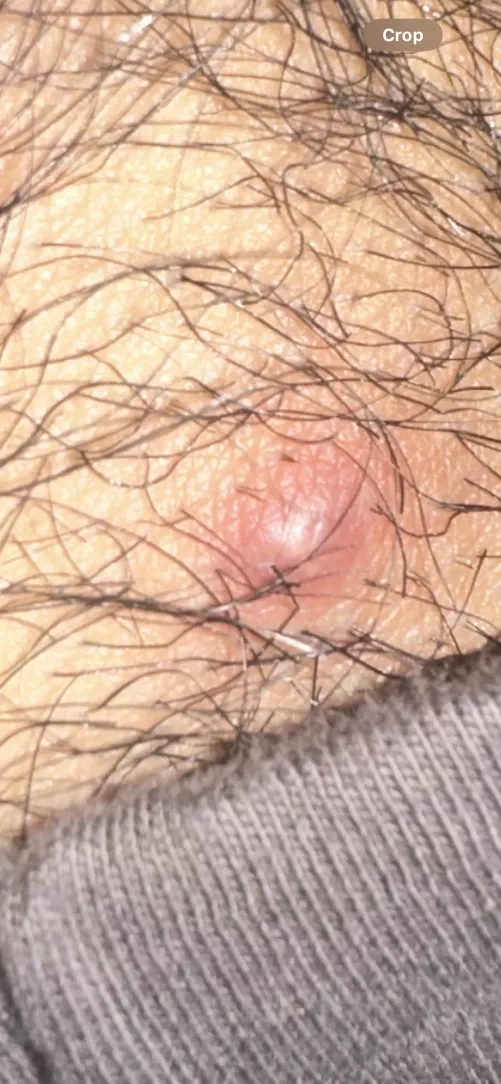 is this infected? Tried popping it yesterday to no avail and now I have a 100f fever by Mental_North_6423