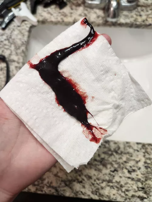 One week post op bloodclot from sinus surgery by noodledoodleloodle