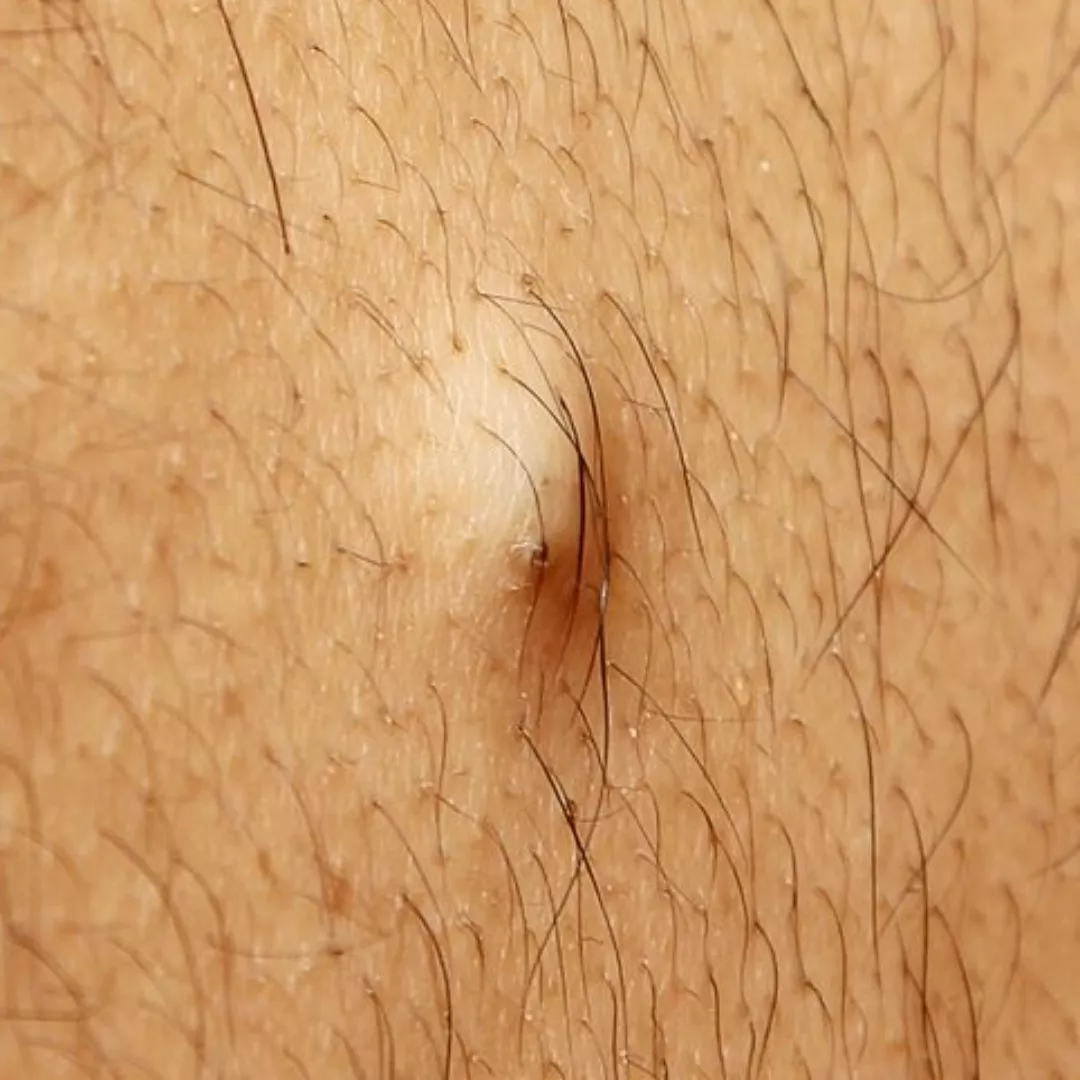 Maybe long shot, but looking for my popping white whale from this sub (?): video, dozens of raised white bumps under skin (see pic for similar) on face, out came only small-medium sized white hard nodules, slight scraping sounds while extracting (tool on posted by iGeroNo