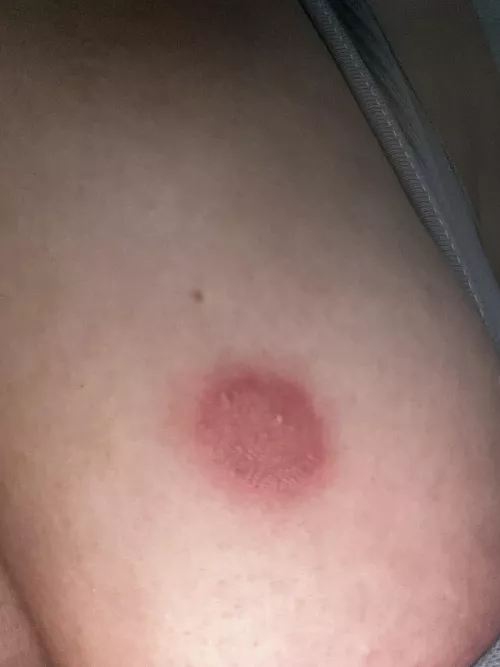 Pustules/ringworm. Forbidden pop! by Dmmousa1
