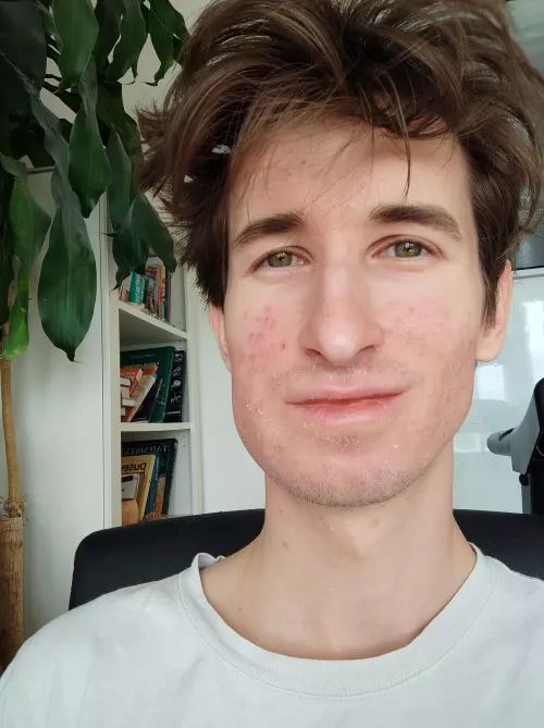 After wisdom tooth extraction 🥲 by kubapp21