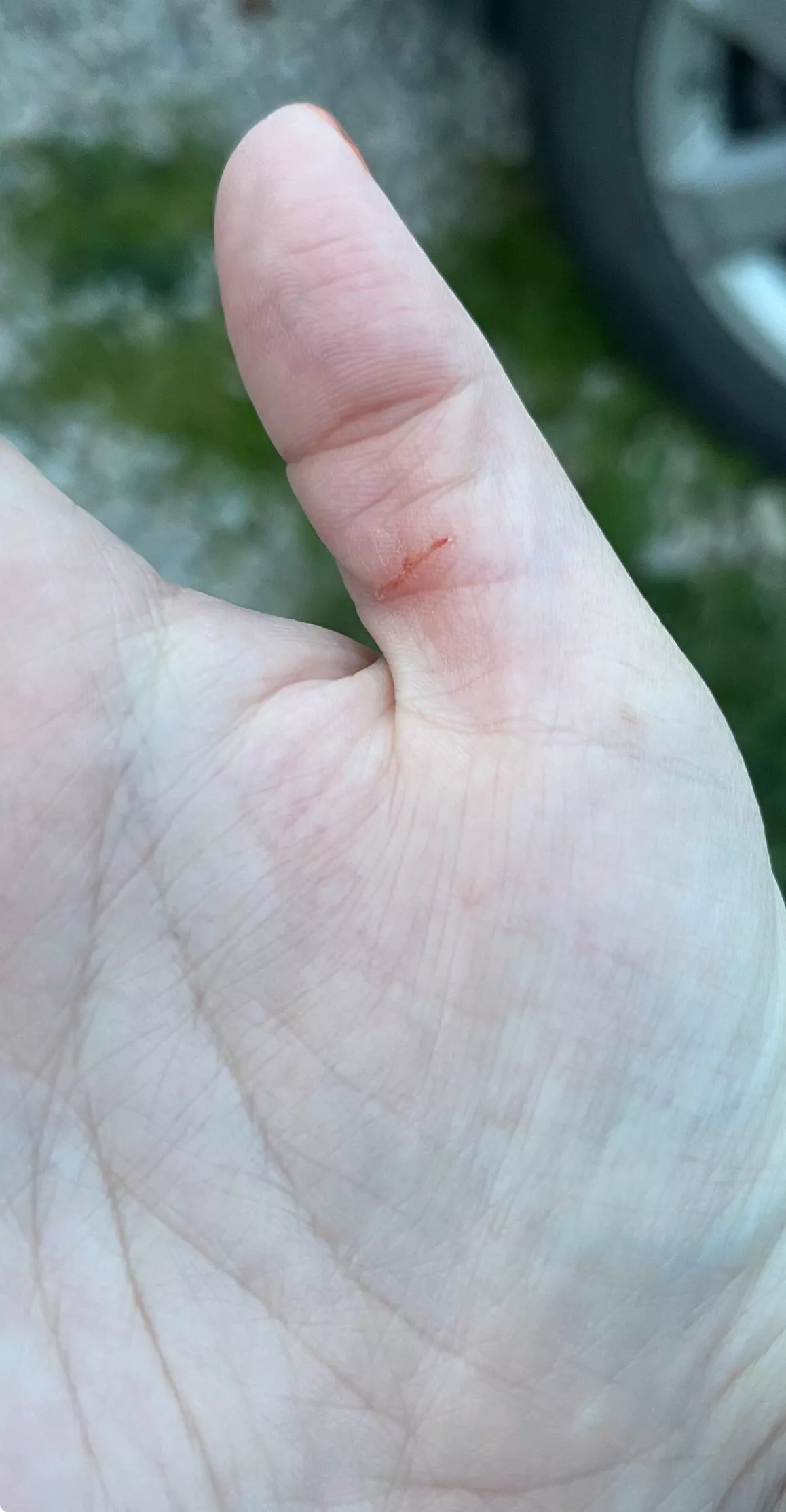 I thought maybe I could handle removing at least some of my cyst. I was wrong. It’s deeper than the picture shows but not deep enough to warrant stitches and I feel a little queasy from the pain in the soft tissue🙃 posted by KaylaRocksss