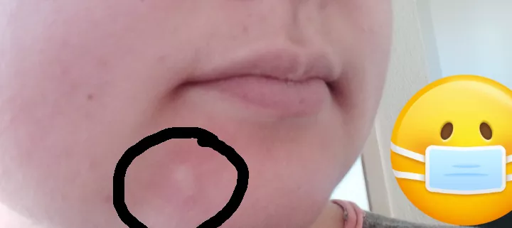 Tried popping, but it doesn't want to yet. Leaking some fluid tho posted by diksap