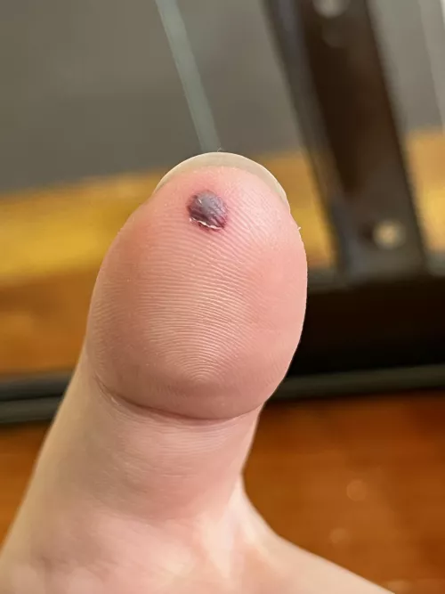 Forbidden! There’s so much pressure I want to pop it. by inconspicuous_aussie