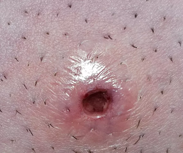 Ingrown hair on pubic region... boil finally popped!  by bobapants