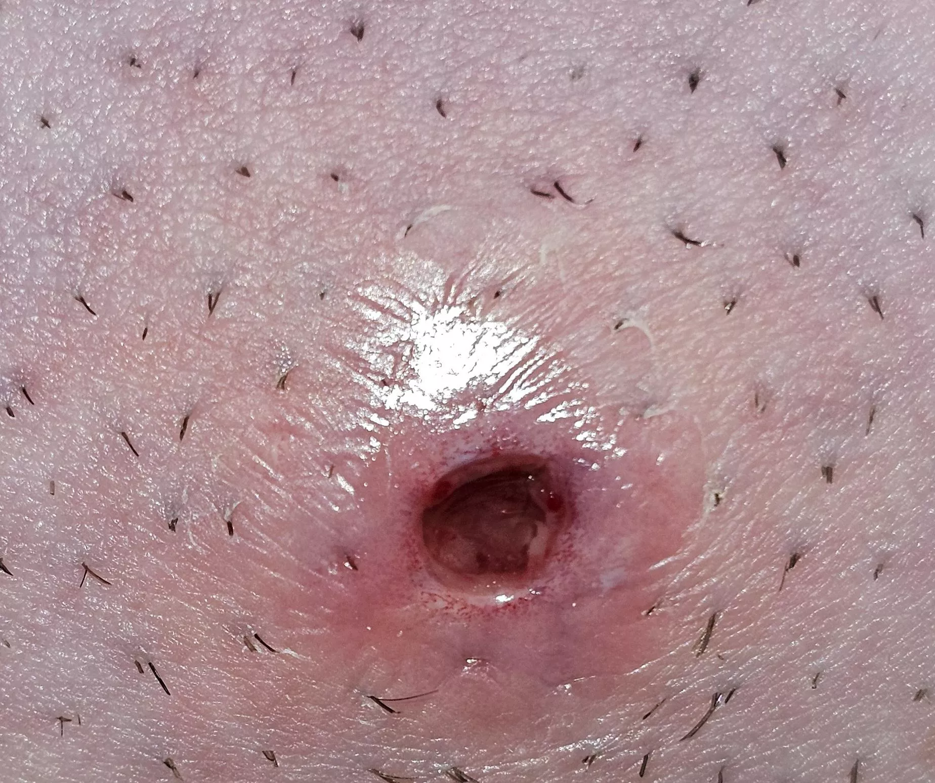 Ingrown hair on pubic region... boil finally popped!  posted by bobapants