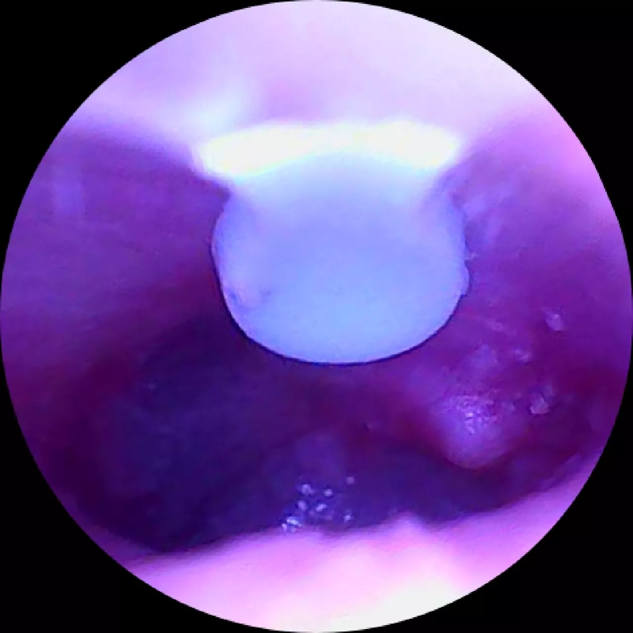 What's this in my ear?, I've been deaf for a week. posted by New-Distribution-562