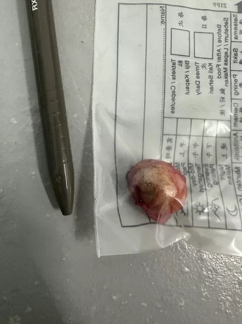 Sebaceous Cyst (Pen for scale) by yungmiaw