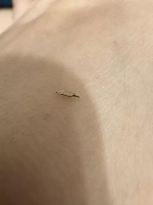 Popped an ingrown after a wax by ohitslikethathuh