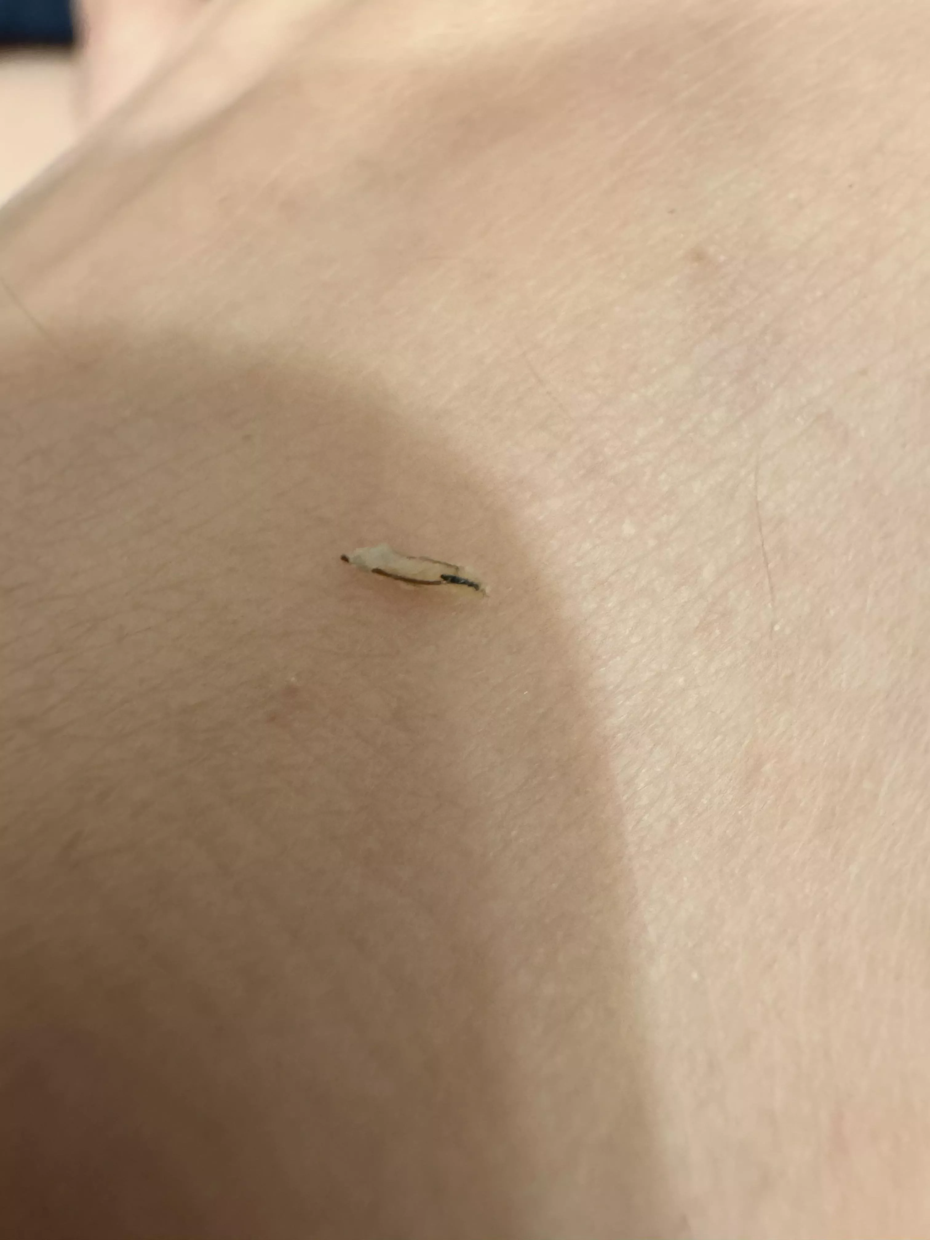 Popped an ingrown after a wax posted by ohitslikethathuh