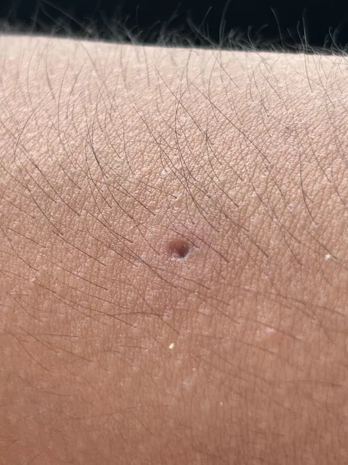 Update: juicy arm cyst by dudebroperson