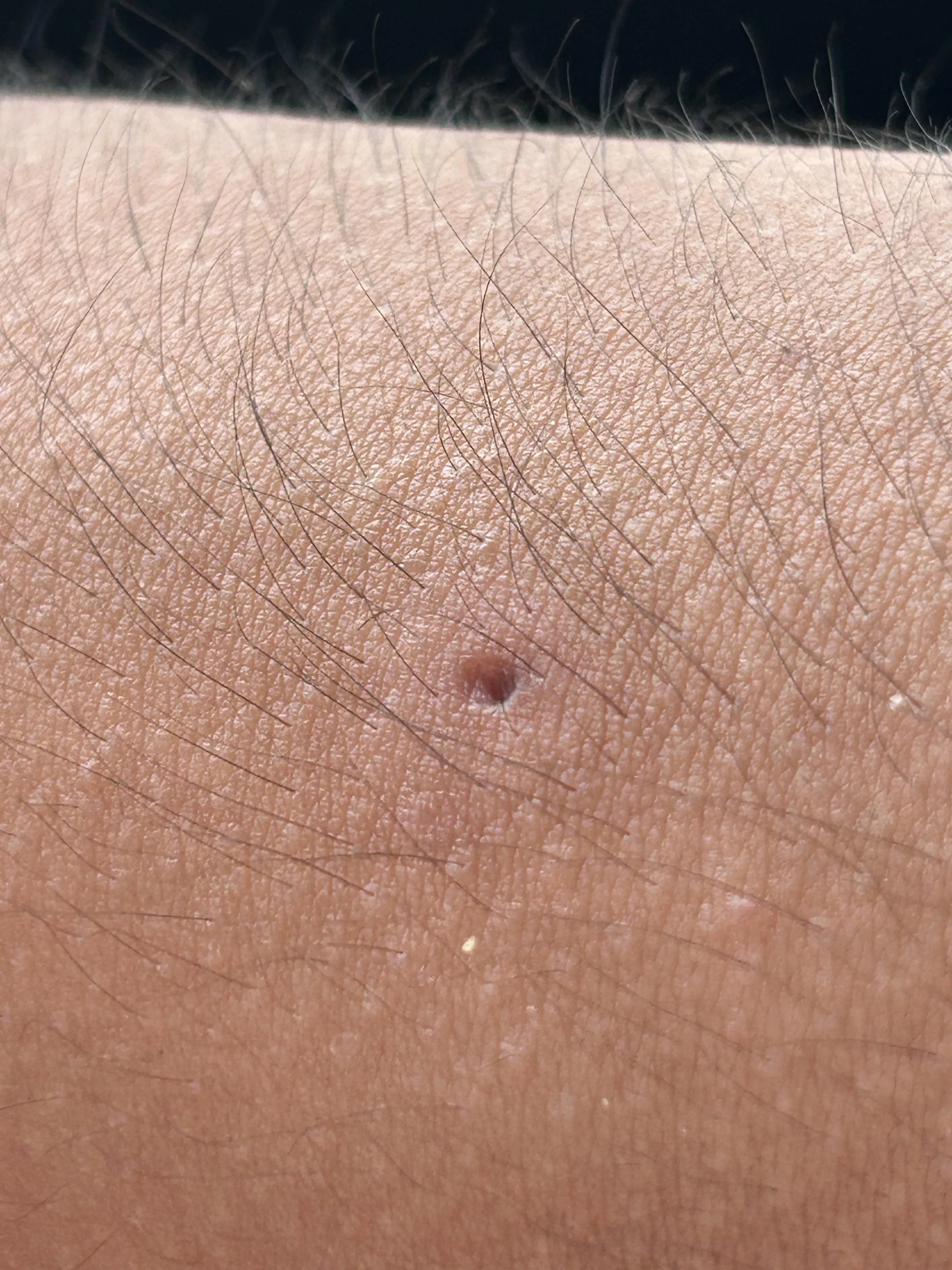Update: juicy arm cyst posted by dudebroperson