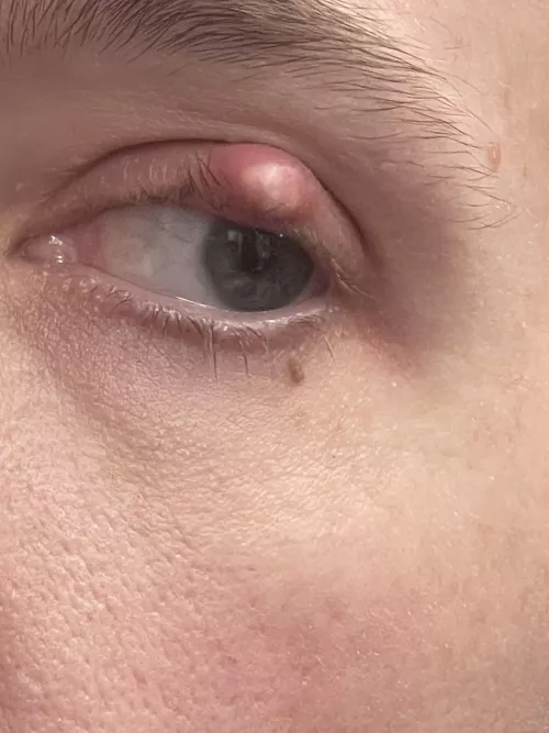 Forbidden pop on my eyelid by dutchesskitty