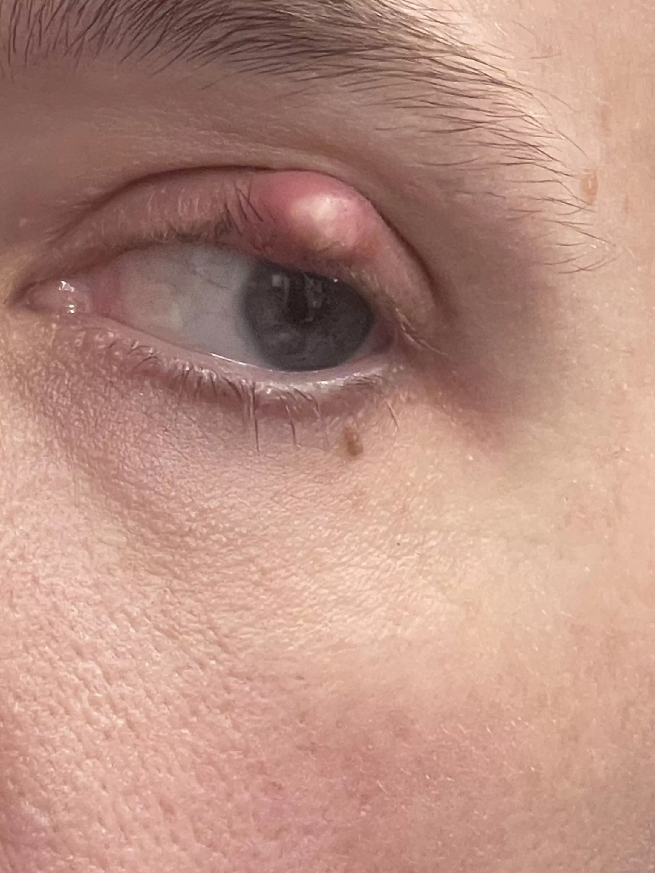 Forbidden pop on my eyelid posted by dutchesskitty