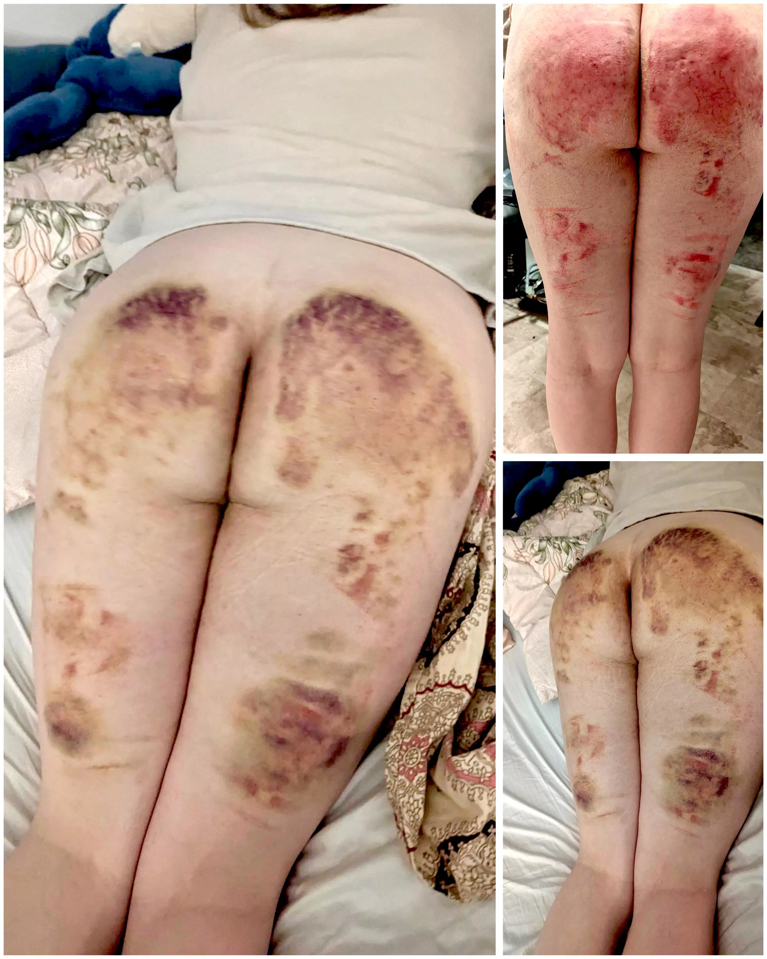 Impact bruises :) posted by HugznD