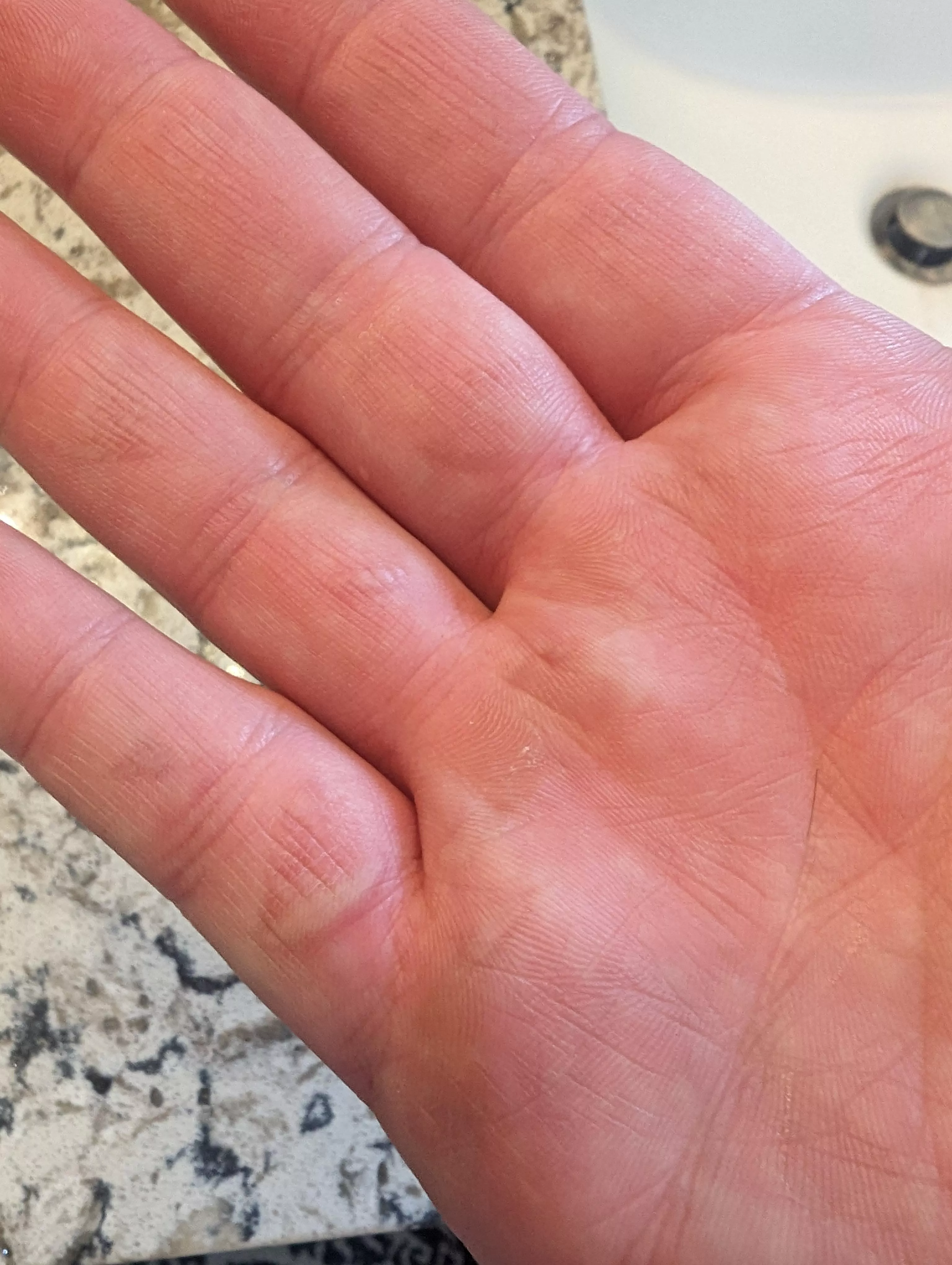 Like an absolute dumbass, I grabbed hot steel while forging with my bare hand posted by RambisRevenge