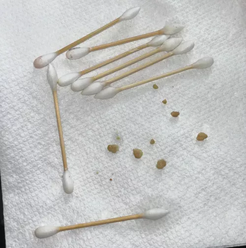 big tonsil stone haul  by clarissacoil