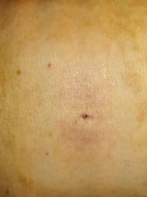 Drained sebaceous cyst hole by Numerous_Pitch_9643