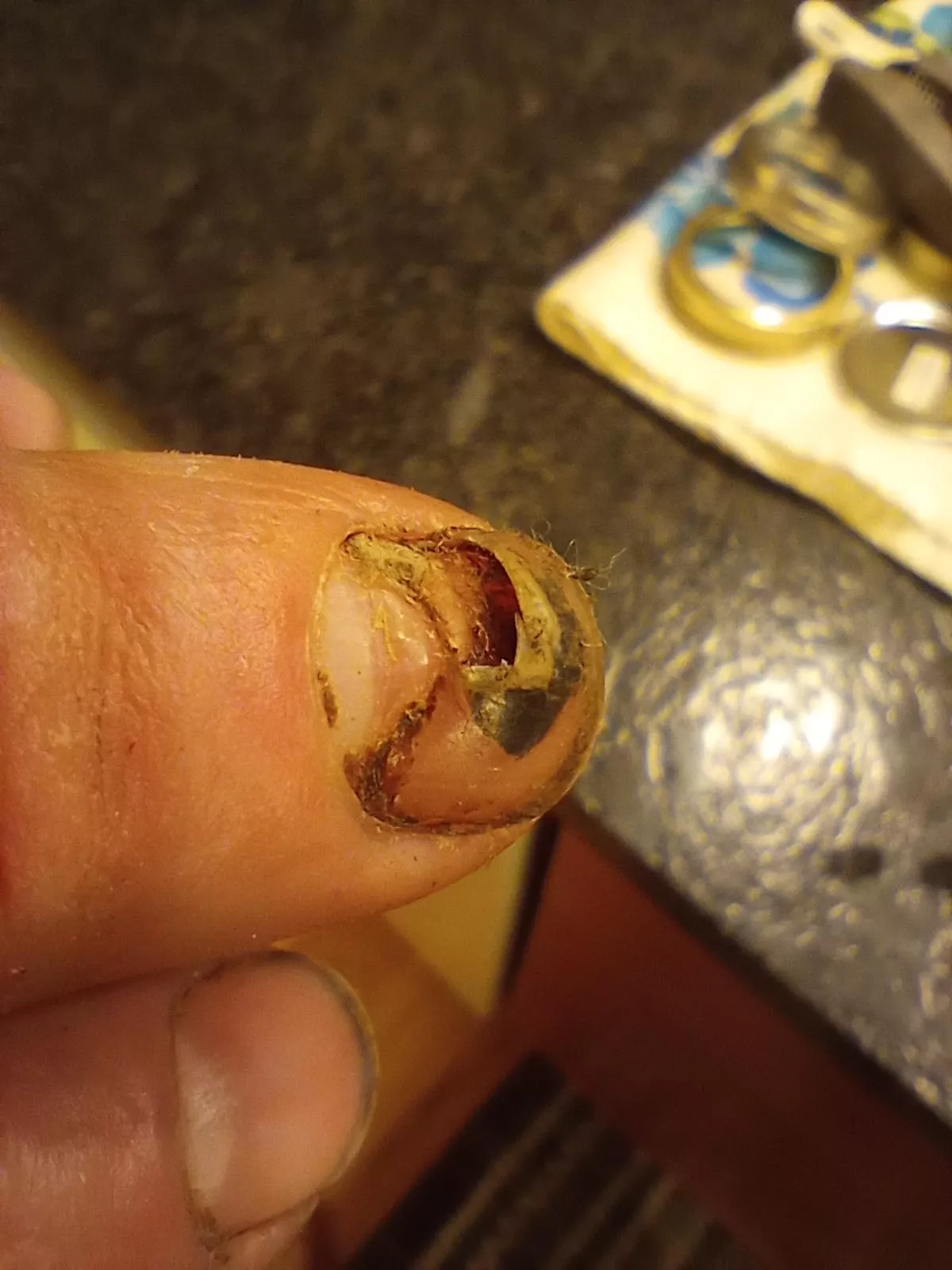 Popping adjacent. I present to you my fingernail pocket, for your viewing pleasure. Wacked my finger with a hammer. posted by stroganoffagoat