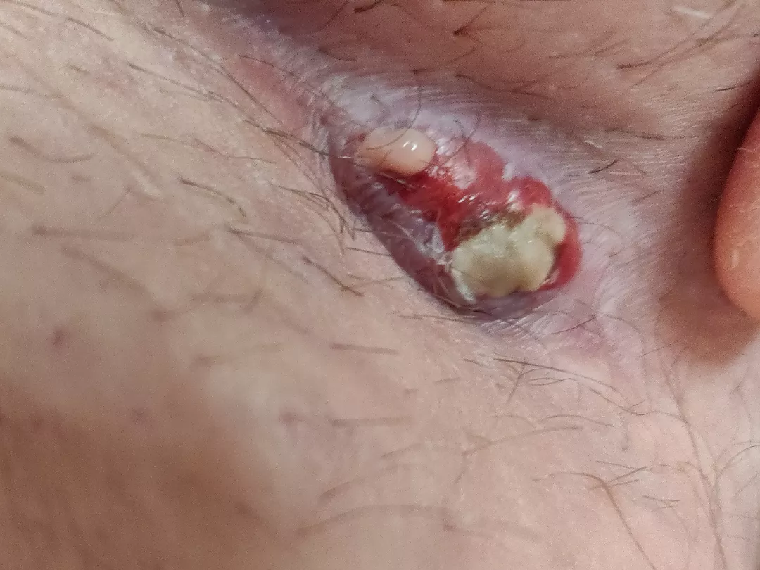 10th hour update, still to painful to pop 💀 posted by skskandns