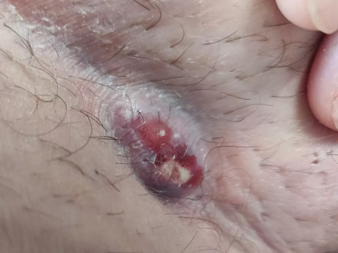 Boil in my groin, wait for the pop!  posted by skskandns