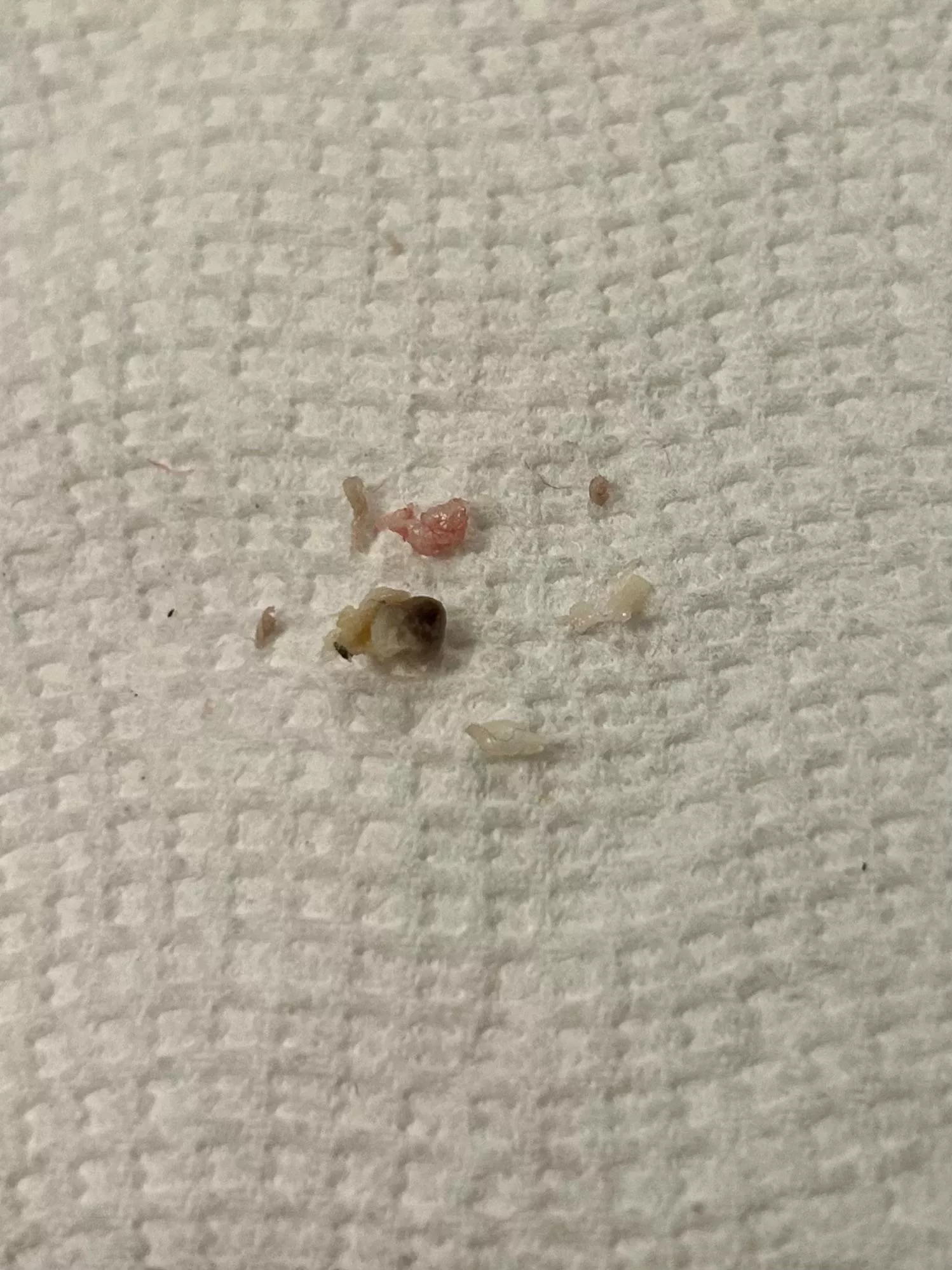 The grody results of what I thought was a regular pimple on my inner thigh from chafing! Wish I'd thought to record the very bloody cyst pop 🍾 posted by bountyhuntergirl