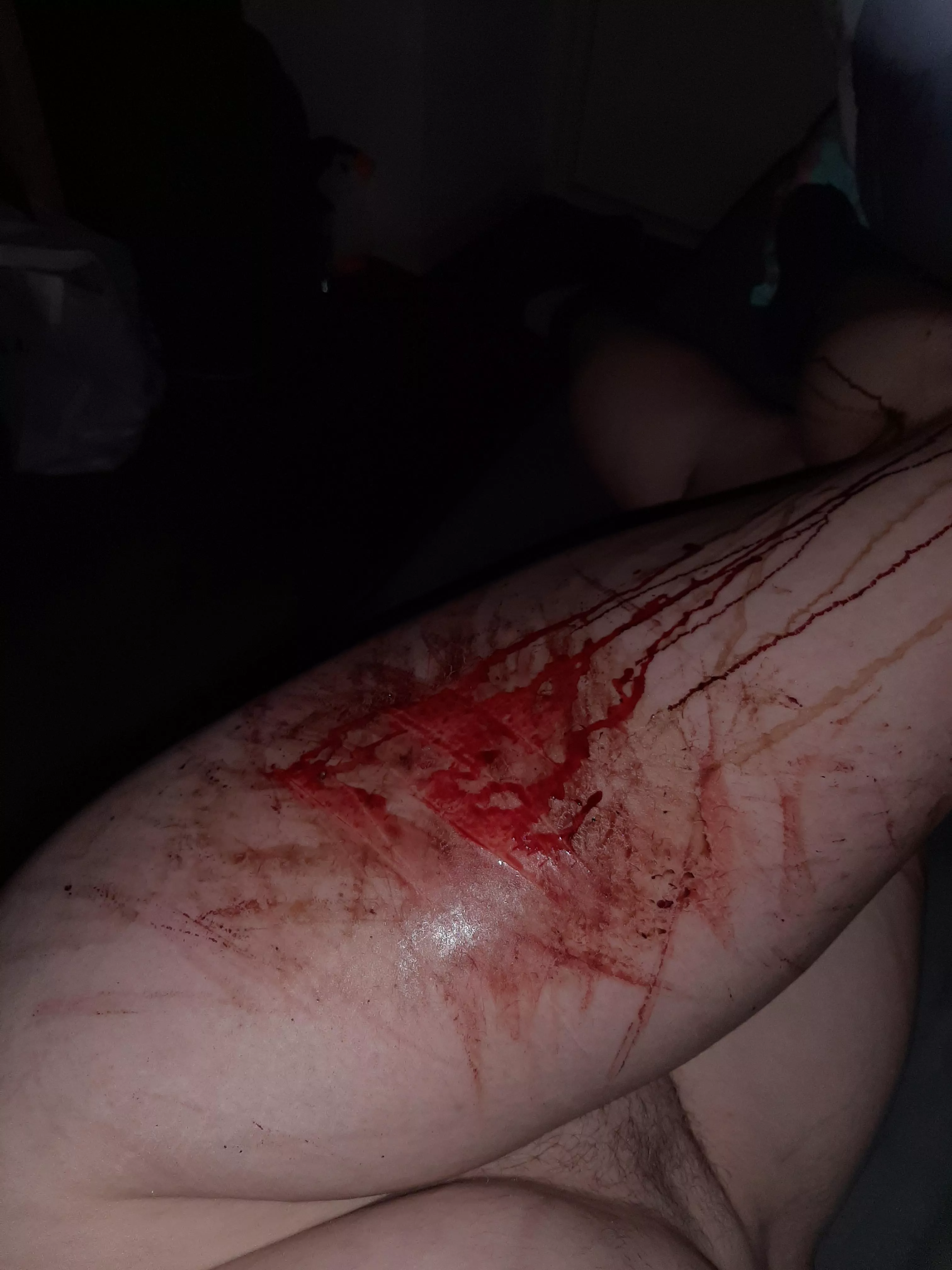 Bleeding brat posted by Forsaken_Resident_20