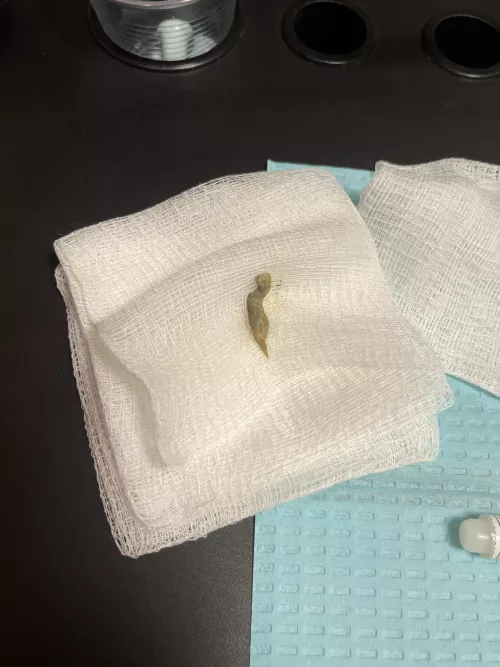 Had ear pain and couldn’t hear for a couple months. After many rounds of ear drops I went to an ENT and they pulled this out by General_Zucchini_580