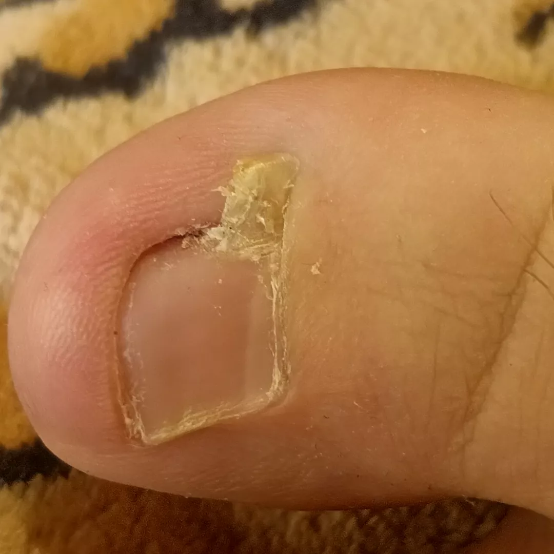 Finally popped this ingrown part of toenail out of my toe. posted by Apanatr