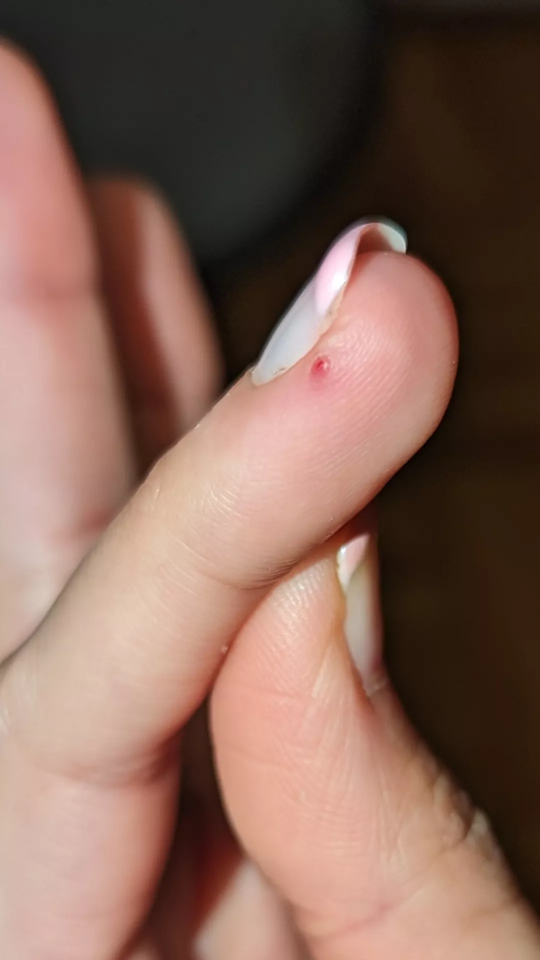 Had this thing on my finger for a while, it was always red, but it just popped, any idea what it could be? posted by ZarkMukurberg