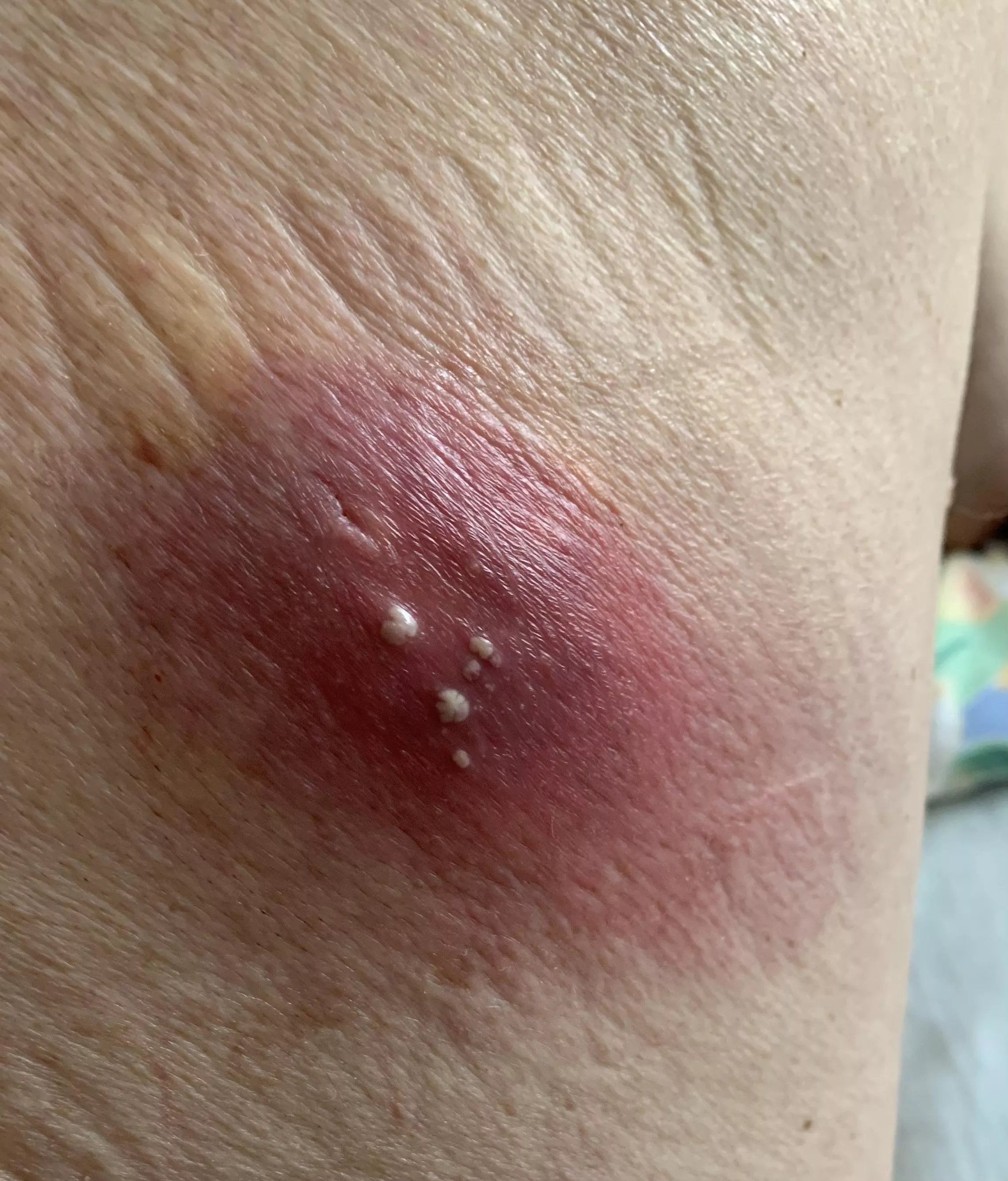 Abscess on my dad’s back posted by Comprehensive-Fix387