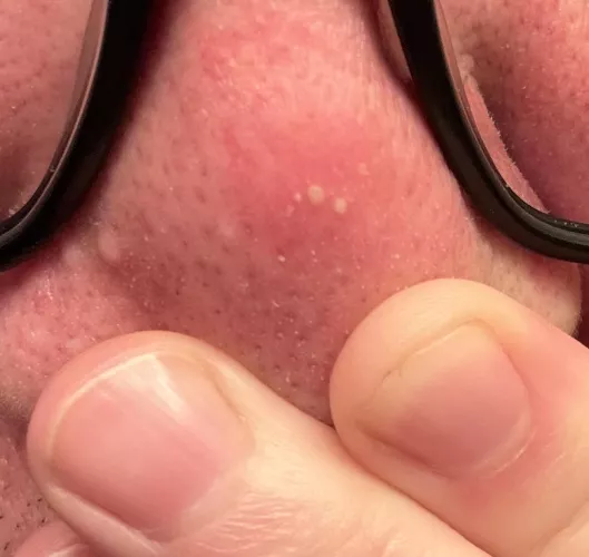 Sometimes my CPAP irritates my nose by pbro42