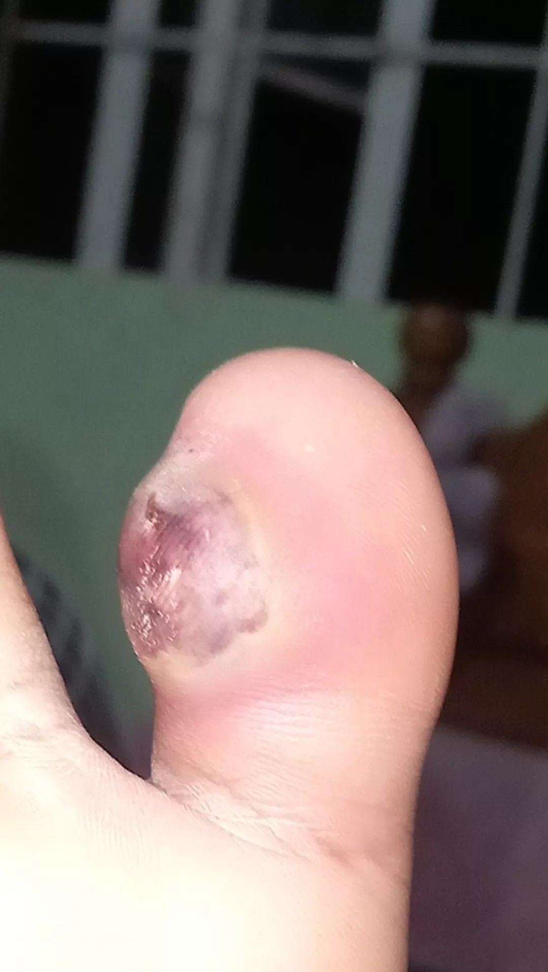 Foot infection? Cyst? posted by Careful_Ad_1388
