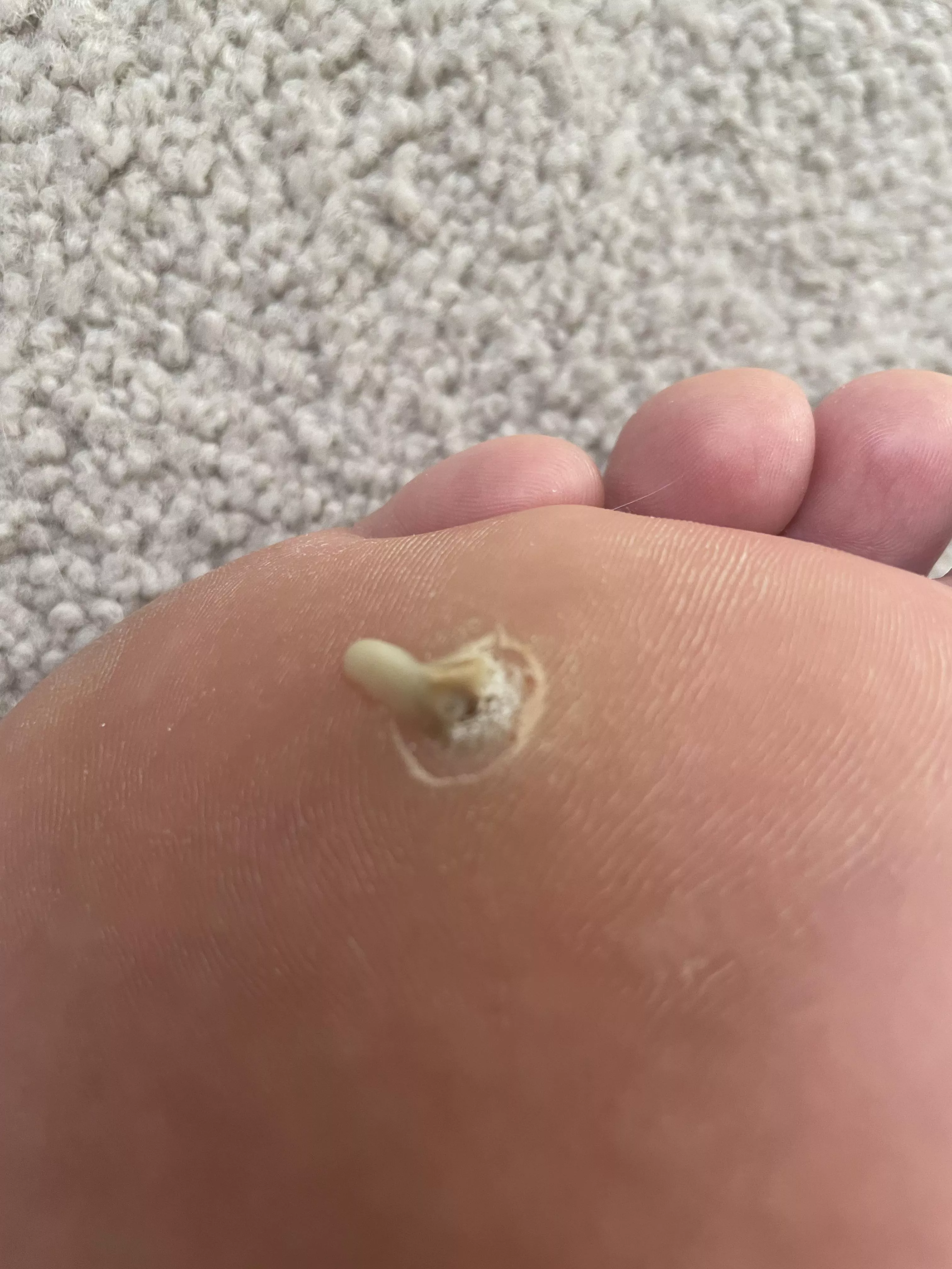 Found out why it hurt to walk on my foot after my plantar wart extraction posted by 0zamataz__Buckshank