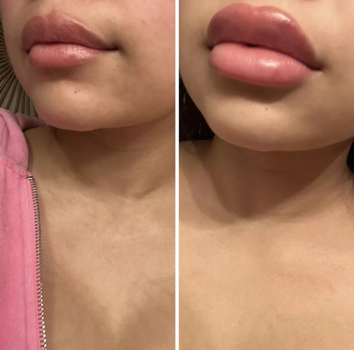 Lip filler progress! Can’t wait for more posted by xojustbri