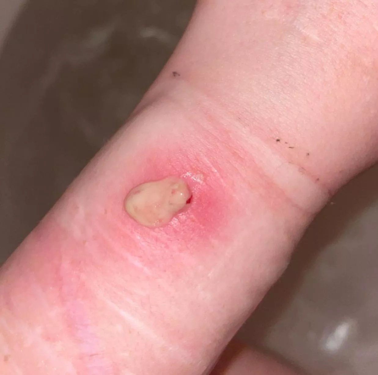 Staph infection boil exploded after 4 days, never ending nasty stuff flowed out posted by Constant-Stranger-26