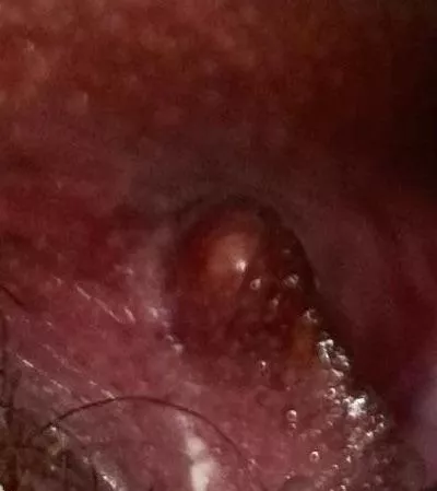 It felt like I had torn my labia, imagine my surprise when I found this thing! Wasn’t sure what it was, so of course I squeezed it and it EXPLODED. Of course I also wasn’t recording because I’m an idjit! posted by ChaoticEnygma