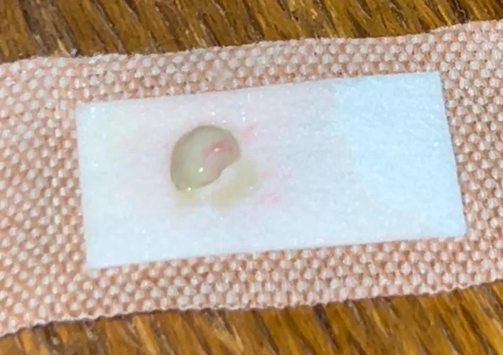 New one for me… an entire, unbroken abscess sac in one piece. Yes, I did my own alien autopsy on it later. by Floxxomer