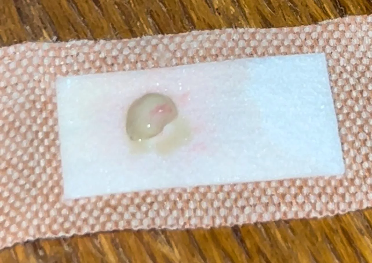 New one for me… an entire, unbroken abscess sac in one piece. Yes, I did my own alien autopsy on it later. posted by Floxxomer