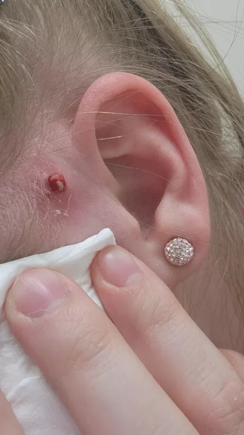 Well guess my MRSA came back again, she is angry 😅 by blondegirly23