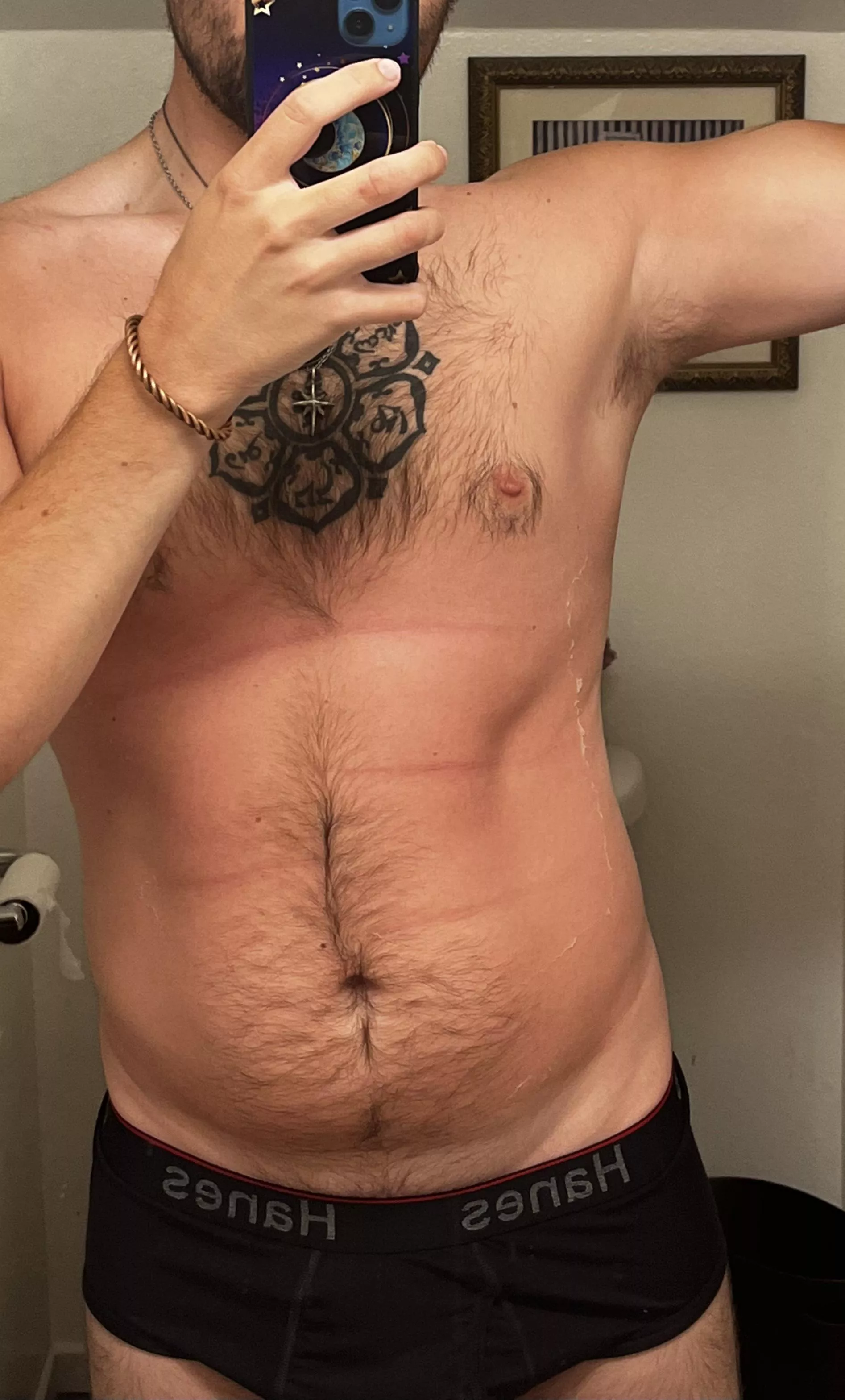So I got a big burnt last week, ignore the peeling.  posted by PlayfulChallenge4614