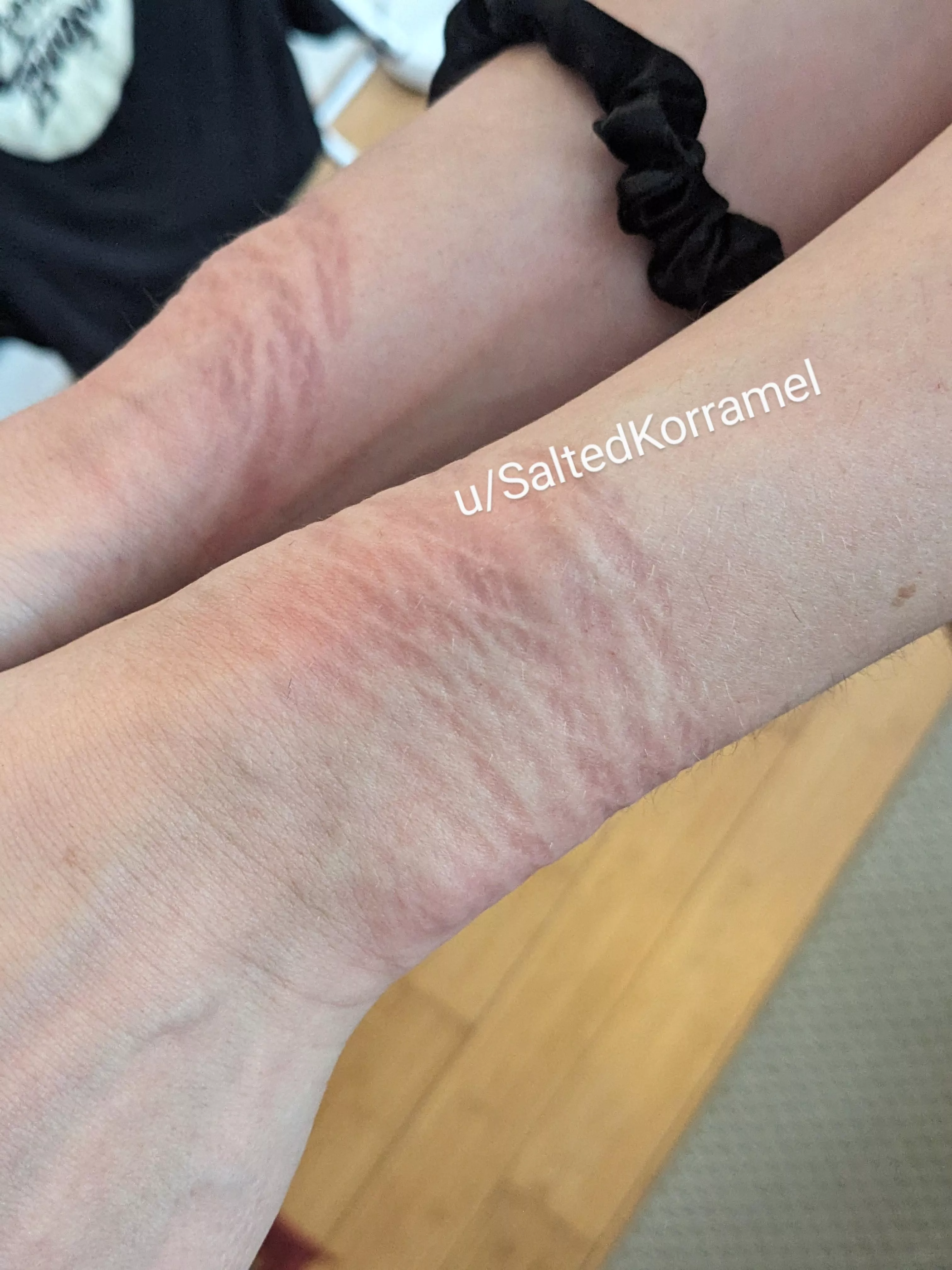 Insane rope marks on my wrists after being bound to a chair and made to cum posted by SaltedKorramel